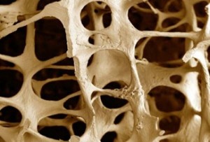 osteoporosi