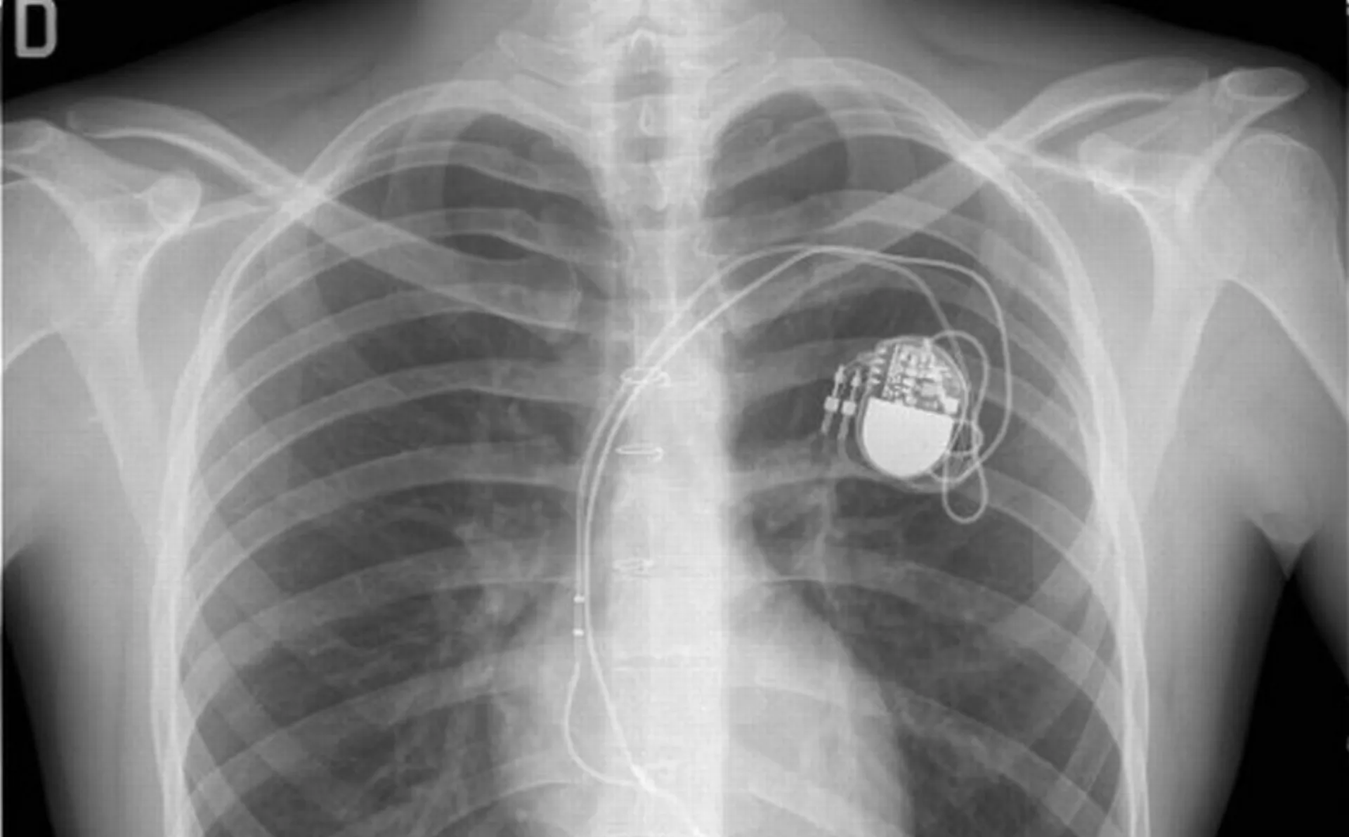 Τον πρόδωσε για ασφαλιστική απάτη… ο βηματοδότης του