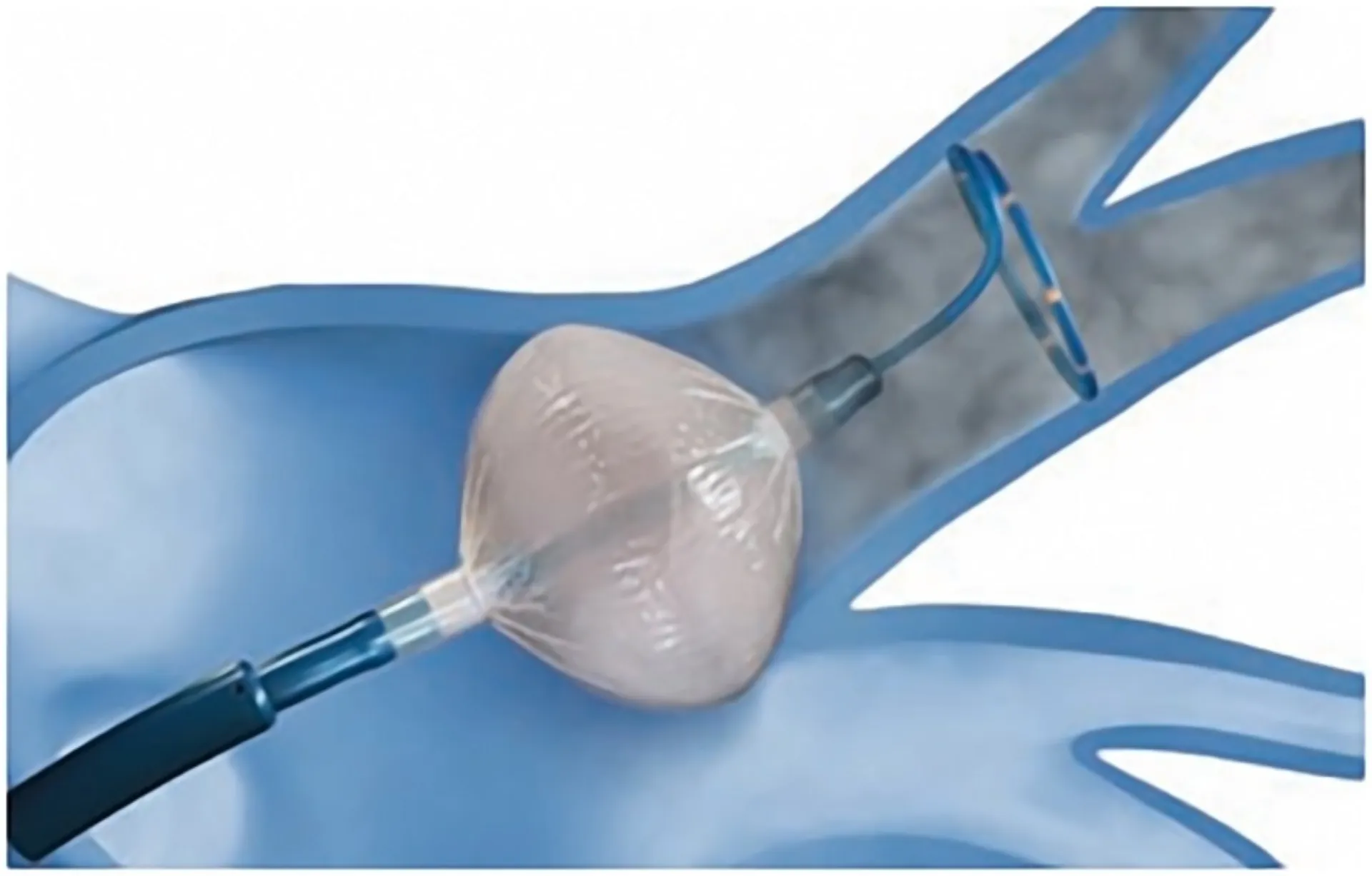 Ιατρικό Κέντρο: Η πρώτη διεγχειρητική κατάλυση πνευμονικών φλεβών με χρήση Cryoballoon στην Ελλάδα