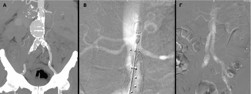 ενδαγγειακή αποκατάσταση αορτικού ανευρύσματος χωρίς ιωδιούχο σκιαγραφικό, Ιατρικό Αθηνών