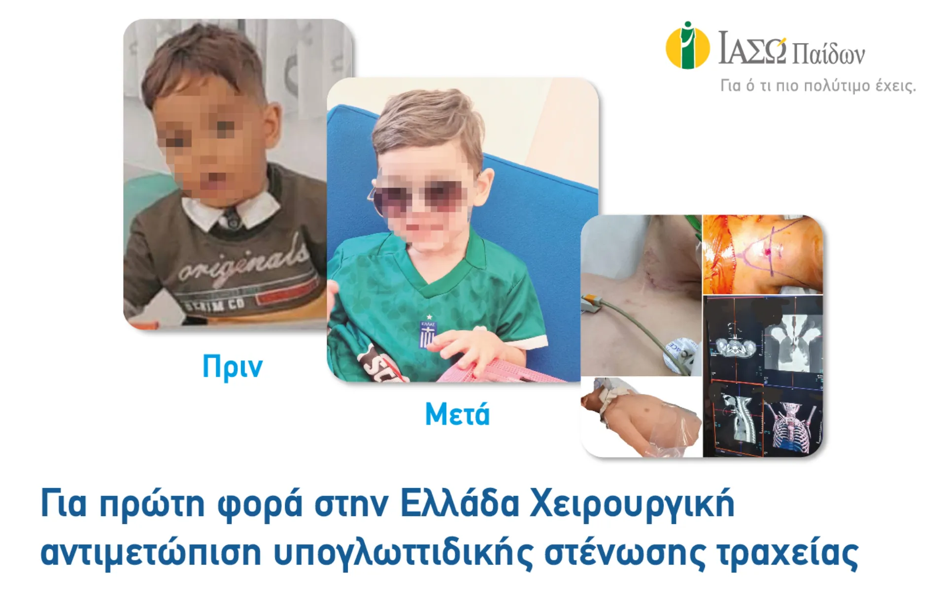 ΙΑΣΩ Παίδων: Για 1η φορά στην Ελλάδα χειρουργική αντιμετώπιση υπογλωττιδικής στένωσης τραχείας