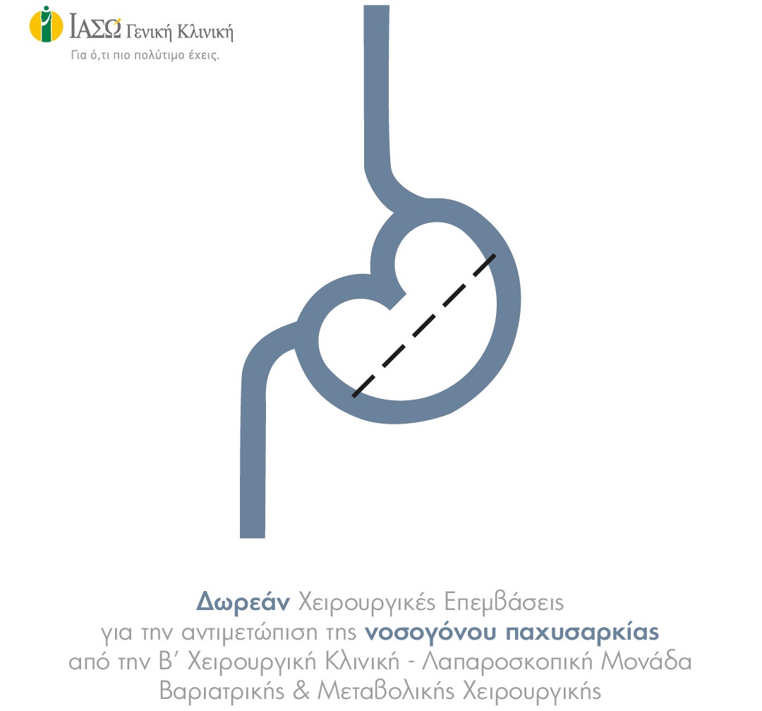 ΙΑΣΩ Γενική Κλινική: Δωρεάν Χειρουργικές Επεμβάσεις για την αντιμετώπιση της Νοσογόνου Παχυσαρκίας