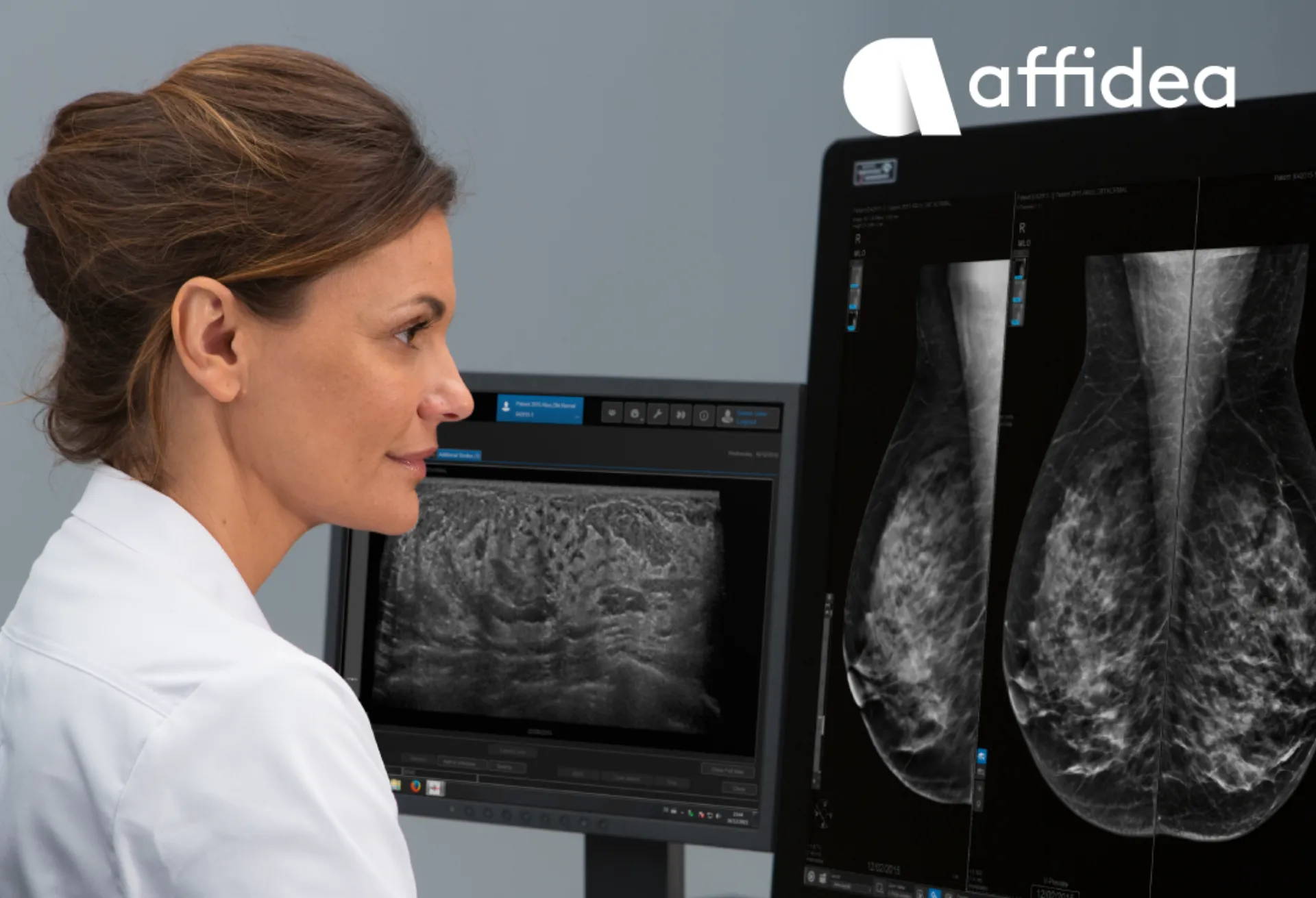 Τι σημαίνει η ταξινόμηση BIRADS στη μαστογραφία και γιατί είναι σημαντική