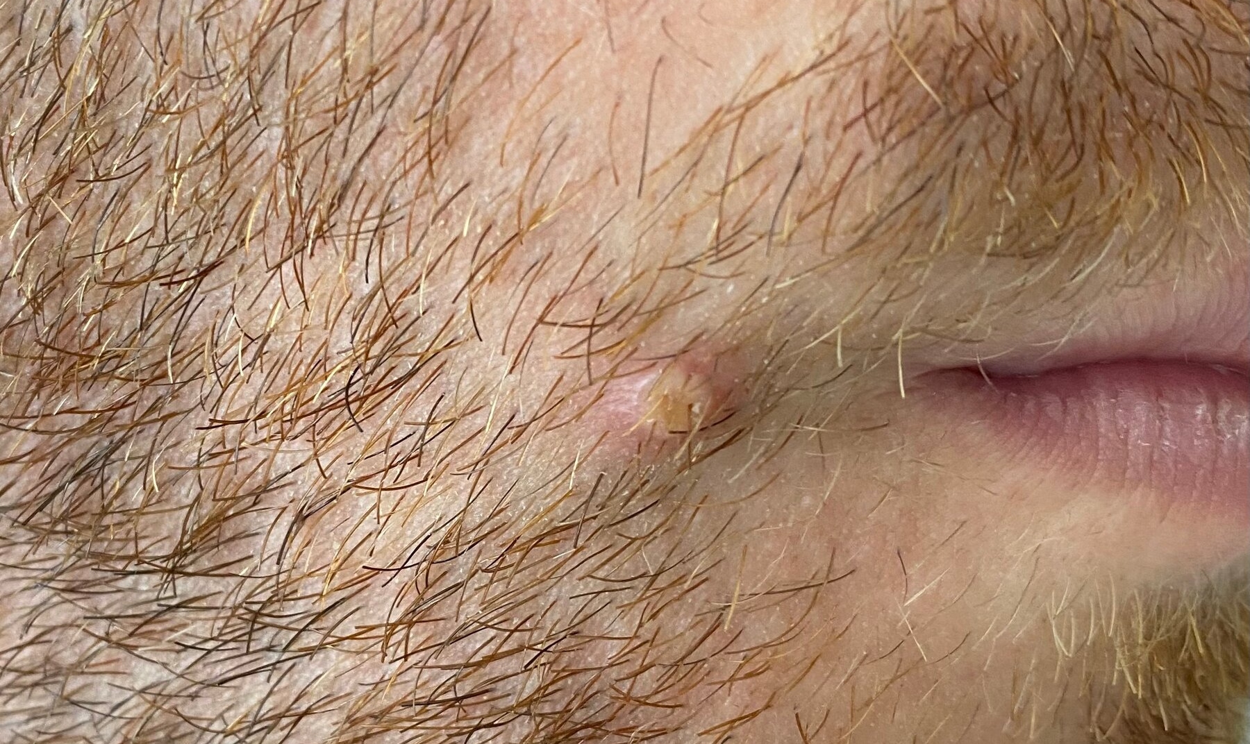 Στη Σουηδία το πρώτο ευρωπαϊκό κρούσμα Ευλογιάς των Πιθήκων